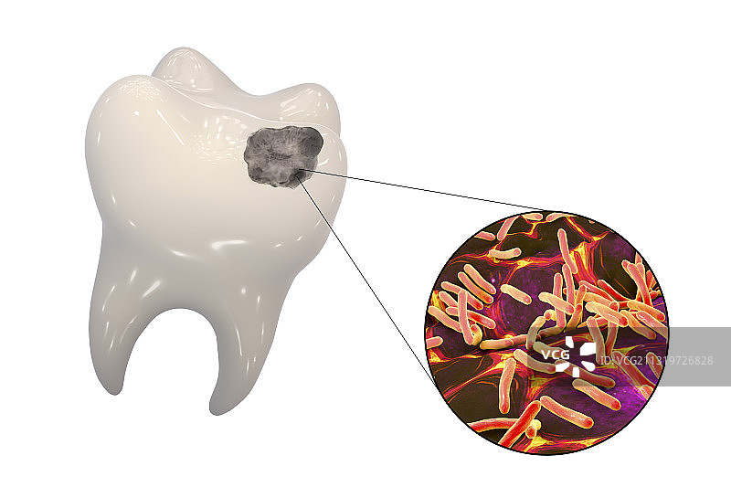 导致龋齿的牙齿腐烂和细菌图片素材