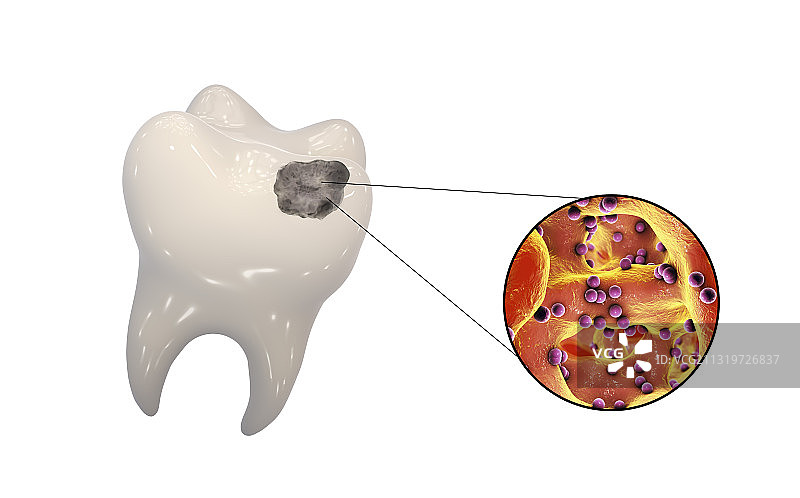 导致龋齿的牙齿腐烂和细菌图片素材