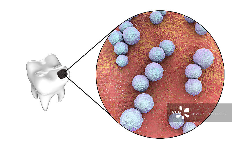 导致龋齿的牙齿腐烂和细菌图片素材
