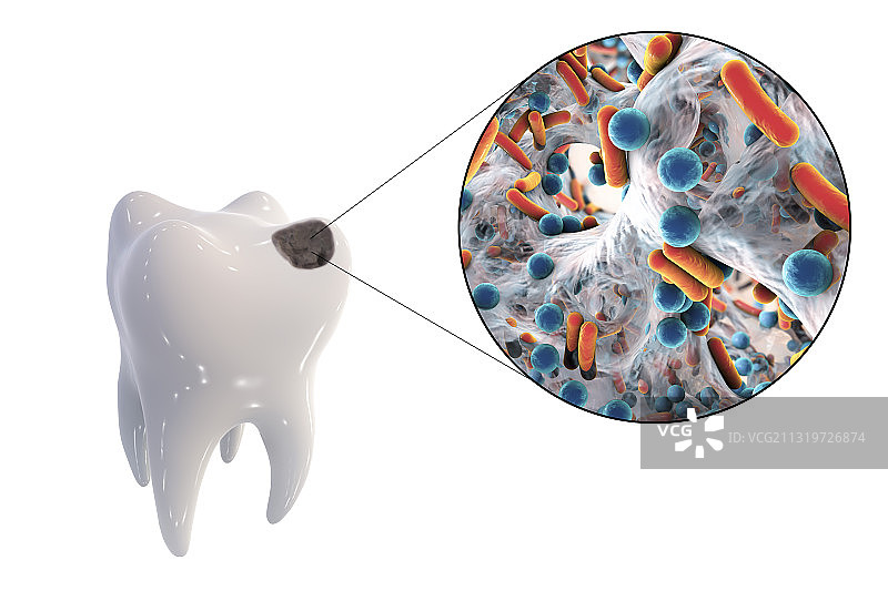 导致龋齿的牙齿腐烂和细菌图片素材