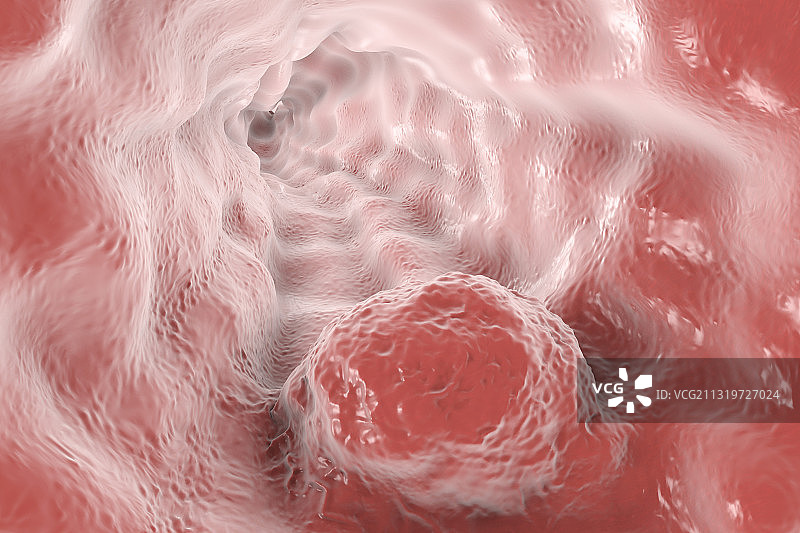 食管癌插图图片素材