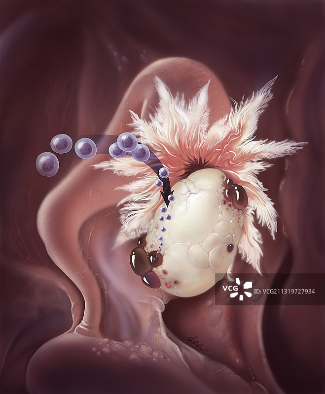 子宫内膜异位症迁移图片素材