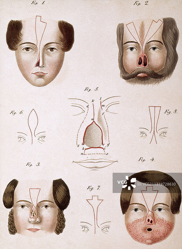 1815年医学文本中的鼻子再造图片素材