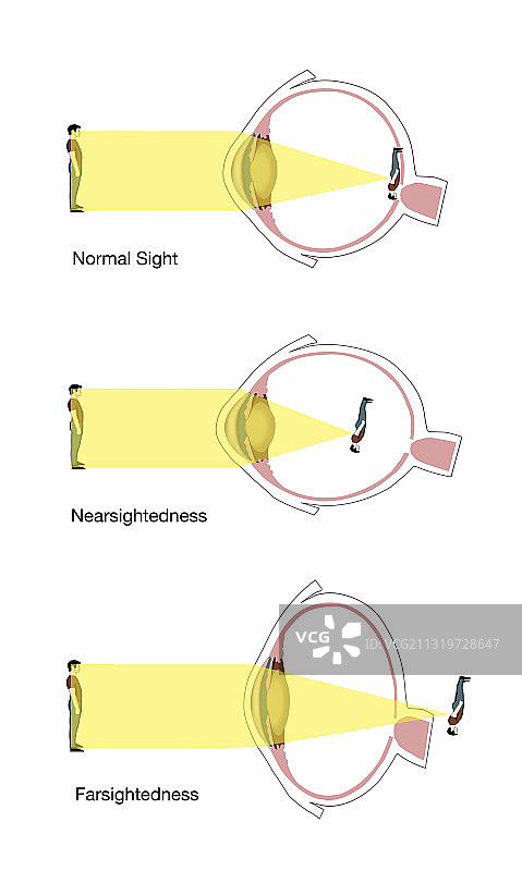 正常、近视和远视图片素材