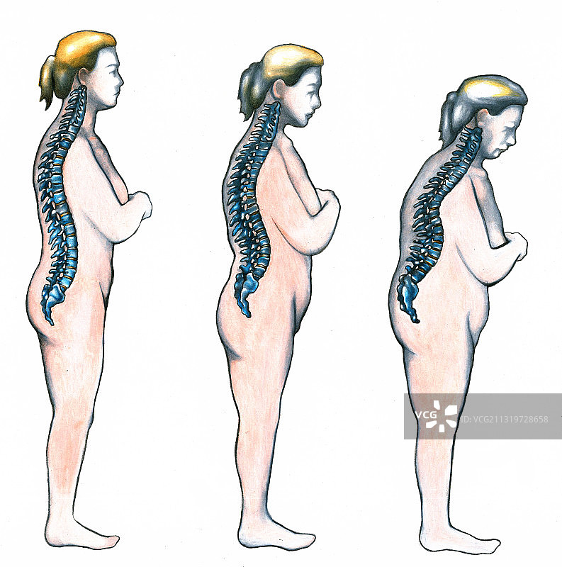 骨质疏松症图片素材