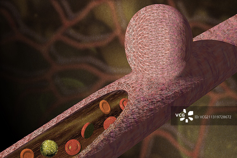 动脉瘤图片素材