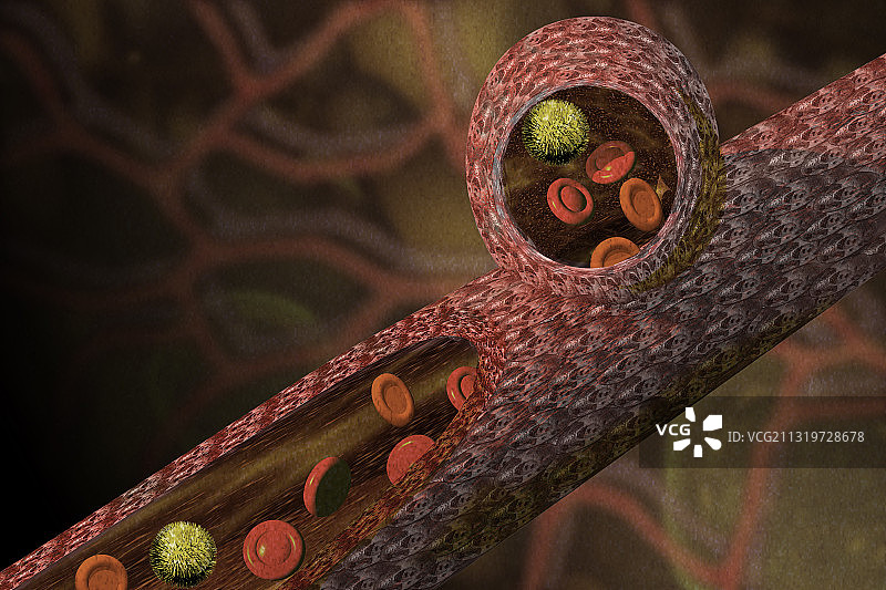 动脉瘤图片素材