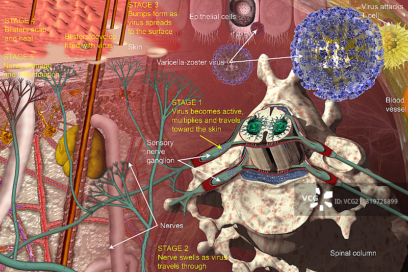 水痘-带状疱疹病毒感染阶段图片素材