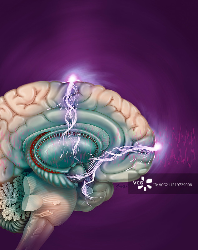 电休克疗法图片素材