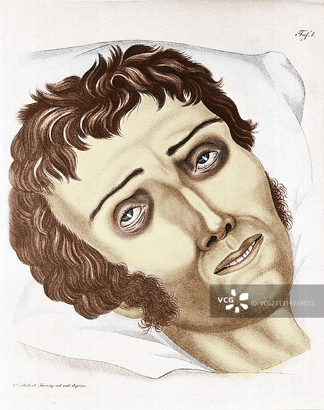 1831年的霍乱病人图片素材