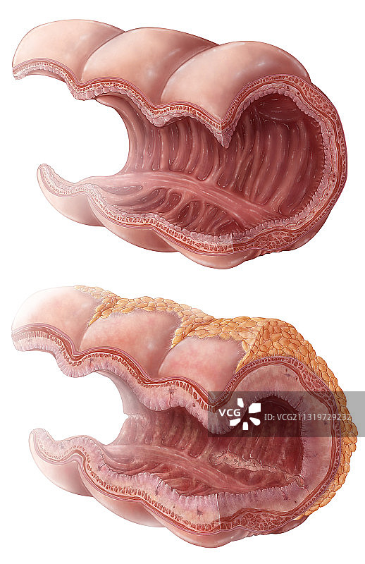 克罗恩病进展图片素材