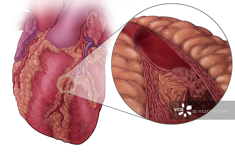 心脏病发作和动脉粥样硬化图片素材