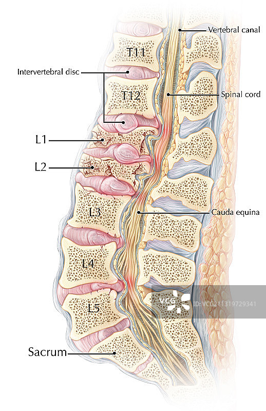 腰椎压缩性骨折图片素材