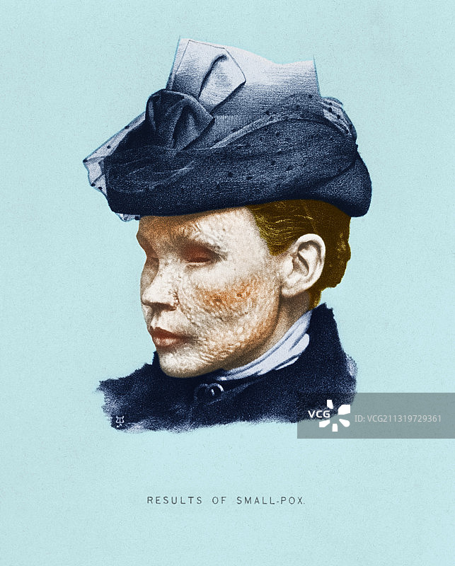 天花患者图片素材