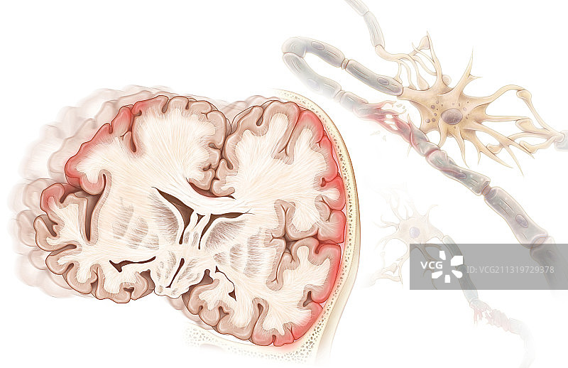 外伤性脑损伤图片素材
