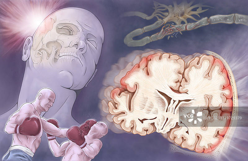 外伤性脑损伤图片素材