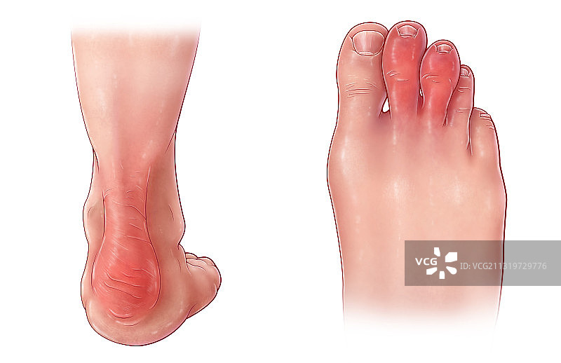 银屑病关节炎症状图片素材