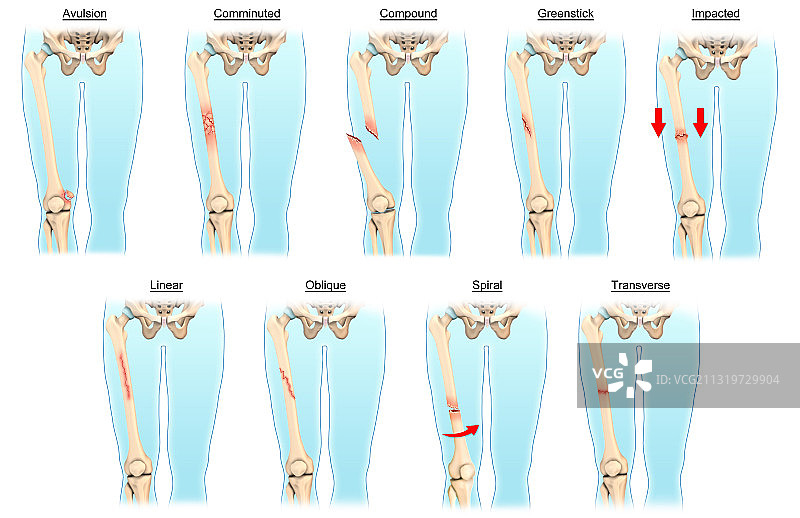 骨折类型图片素材