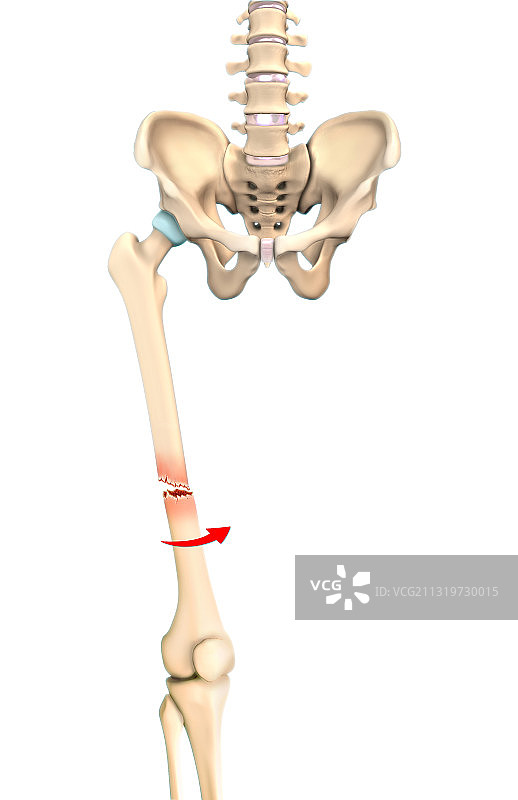 螺旋骨折插图图片素材
