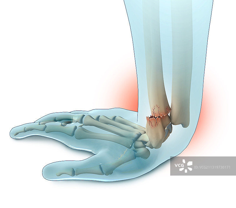科莱斯骨折图示图片素材