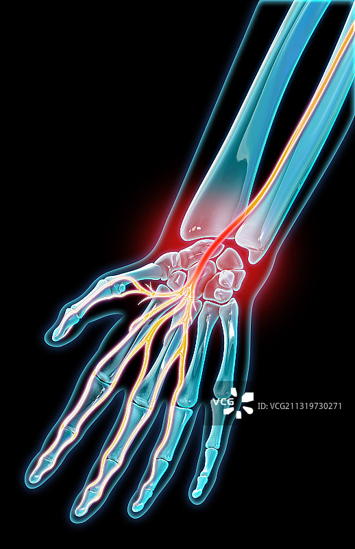 腕管综合征插图图片素材