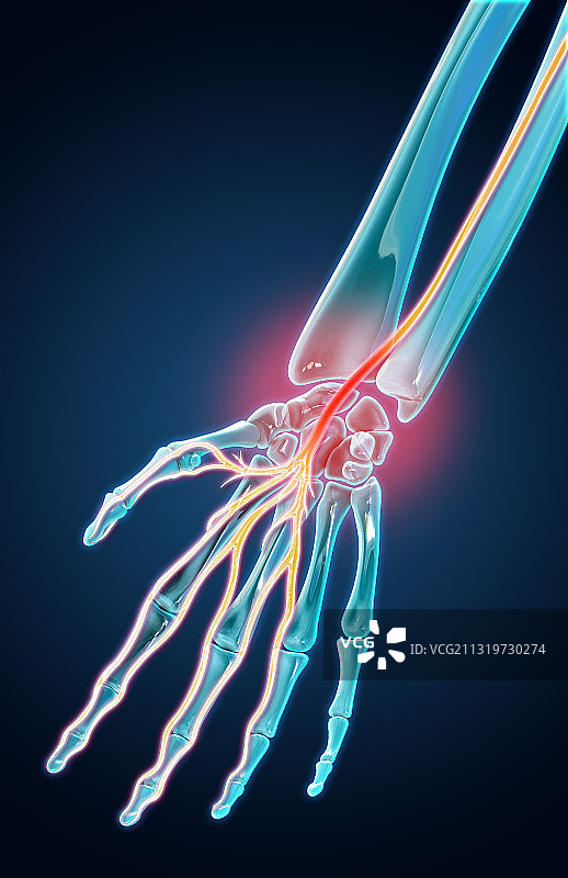 腕管综合征插图图片素材