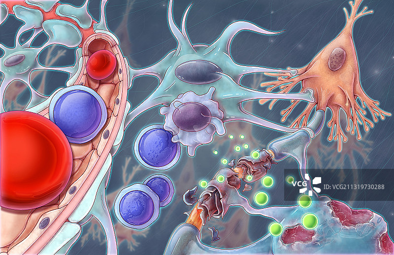 多发性硬化症血脑屏障插图图片素材