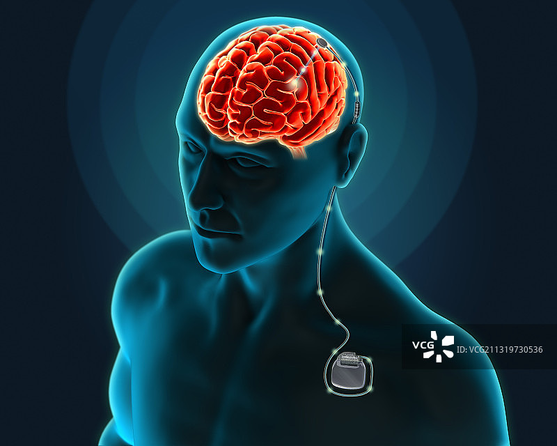 深部脑刺激疗法，图示图片素材