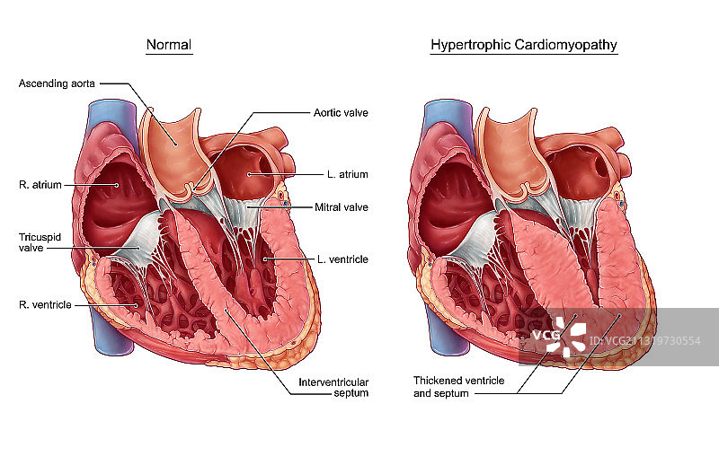 肥厚型心肌病图片素材