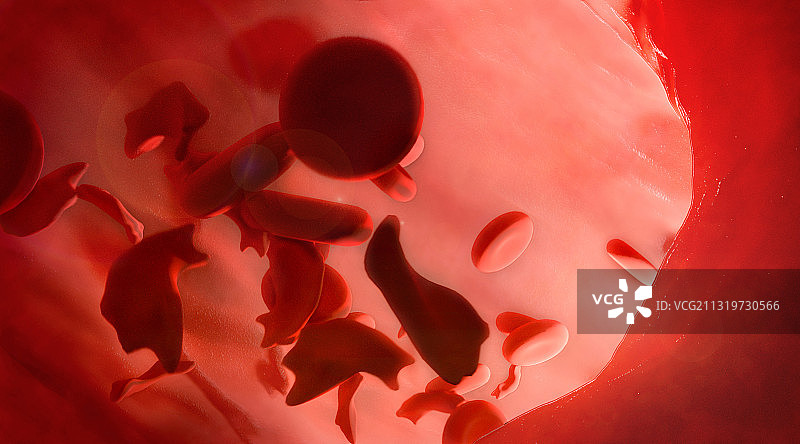 镰状细胞病图示图片素材