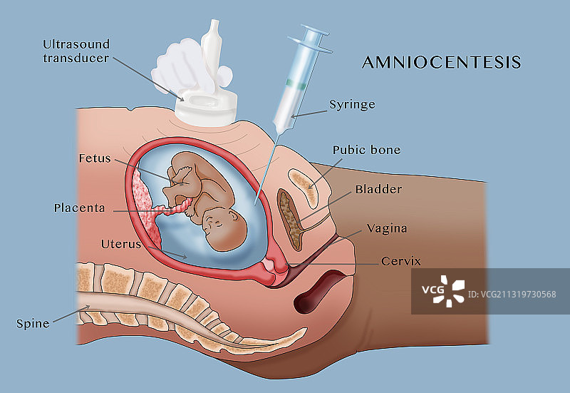 羊膜穿刺术插图图片素材