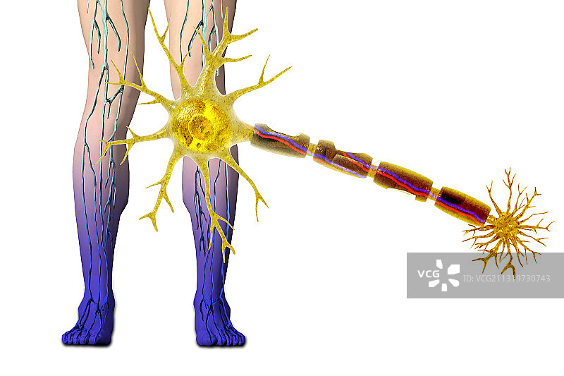 糖尿病神经病变插画图片素材