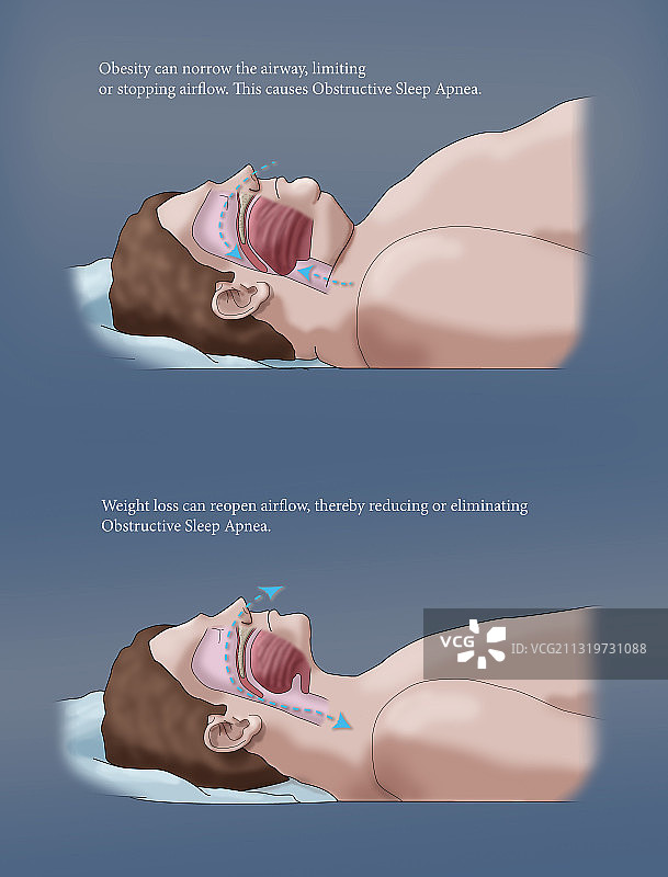 肥胖与睡眠呼吸暂停插图图片素材