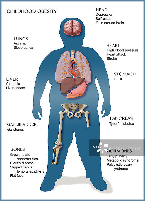 儿童肥胖对健康的影响插图图片素材
