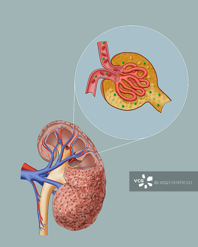 慢性肾病和肾小球图片素材
