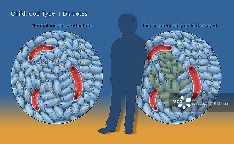 儿童1型糖尿病图片素材