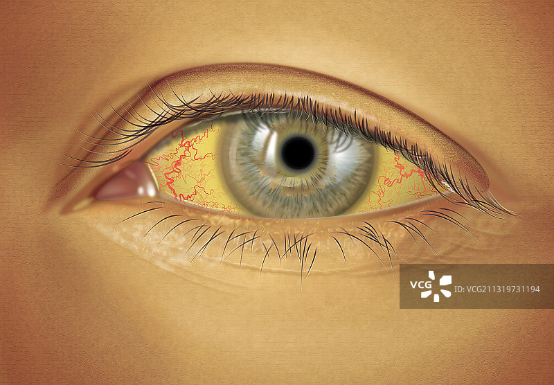 严重的巩膜黄疸图片素材