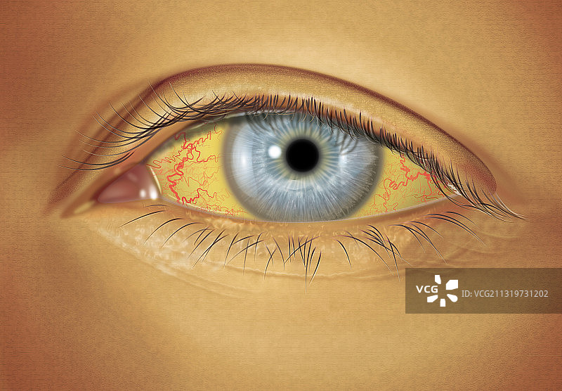 严重的巩膜黄疸图片素材