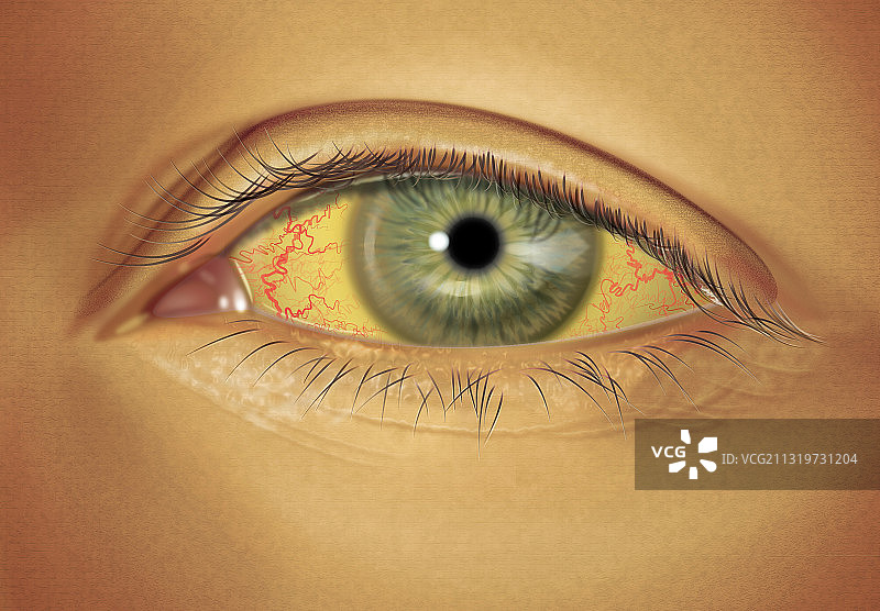 严重的巩膜黄疸图片素材