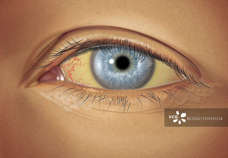 中度巩膜黄疸图片素材