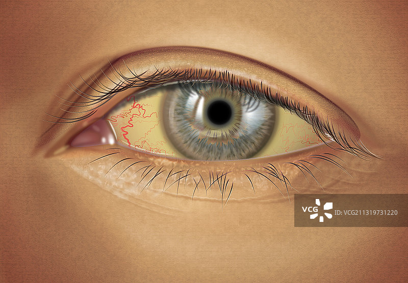 中度巩膜黄疸图片素材