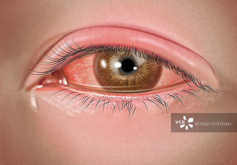 严重病毒性结膜炎图片素材