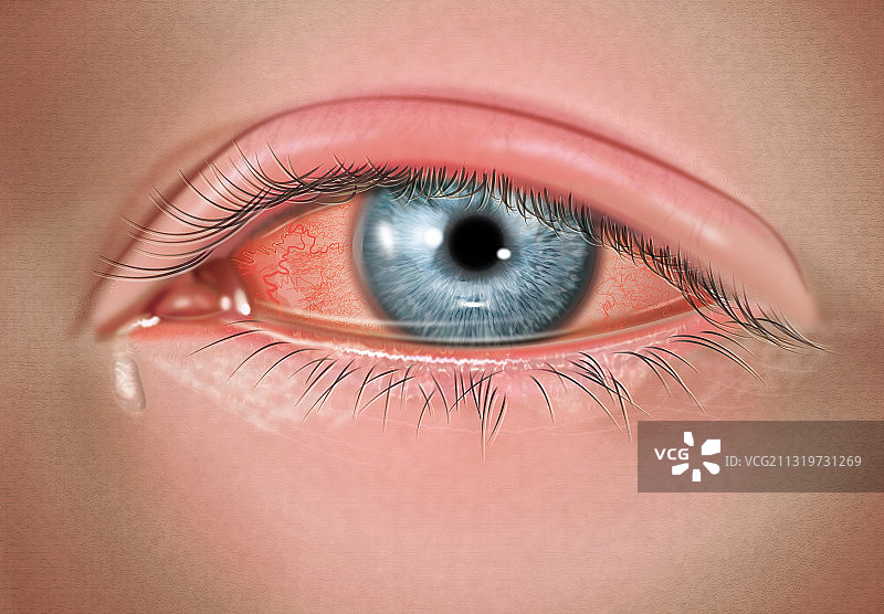 严重病毒性结膜炎图片素材