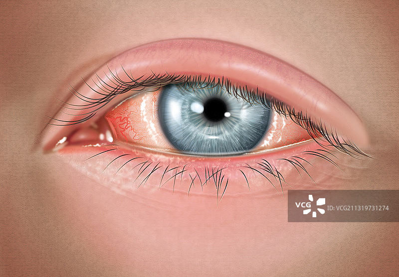 严重的过敏性结膜炎图片素材