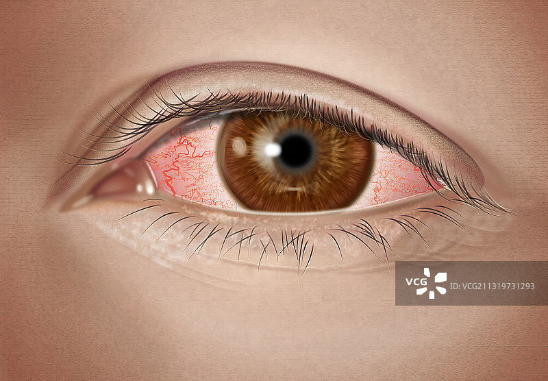 中度过敏性结膜炎图片素材