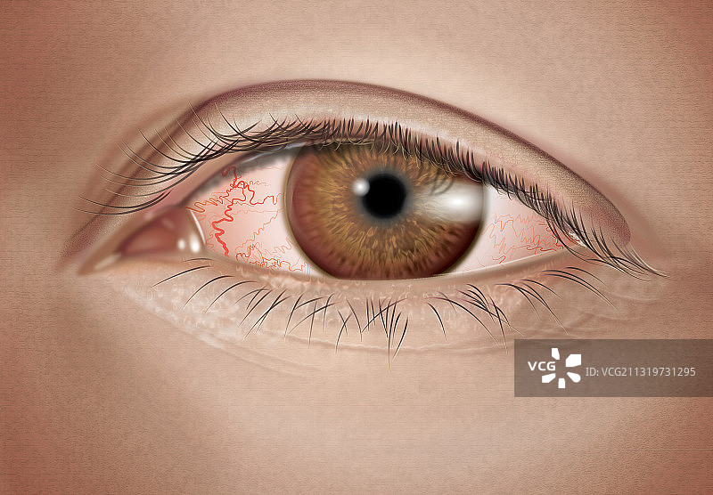 轻度过敏性结膜炎图片素材