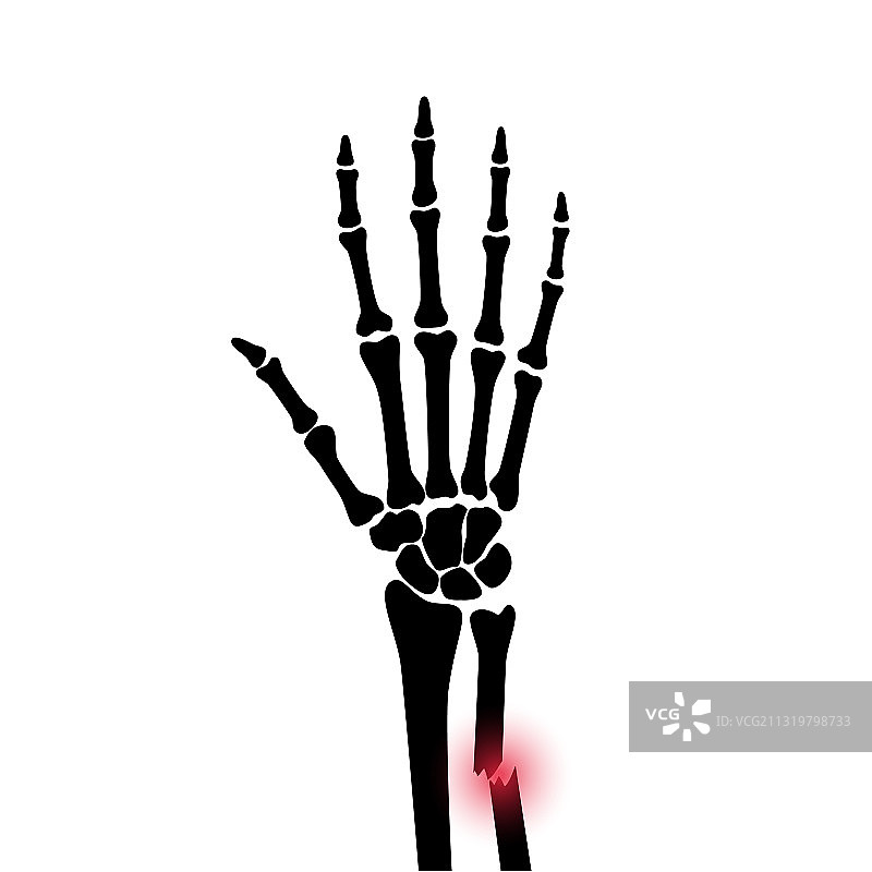 骨折X光概念图片素材