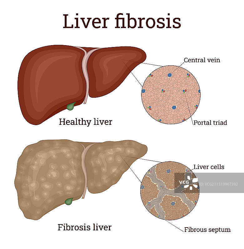 肝纤维化图片素材
