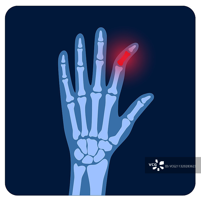 关节炎X光片图片素材