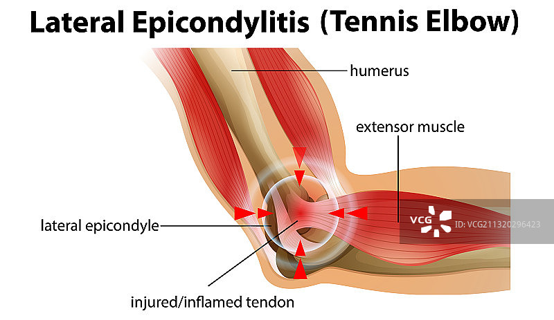 肱骨外上髁炎或网球肘图片素材